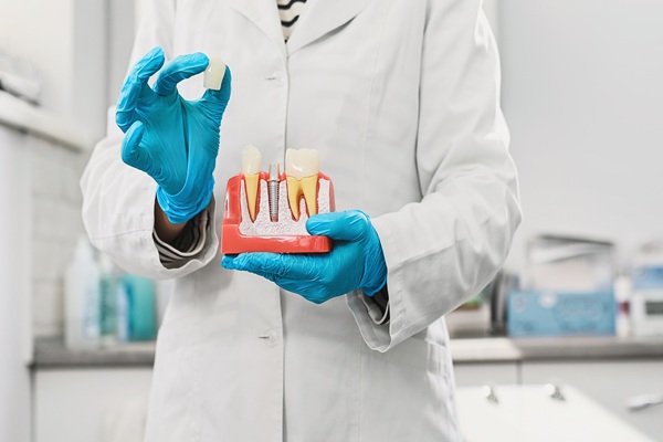 Dental Crown Placement: Front Vs  Back Teeth